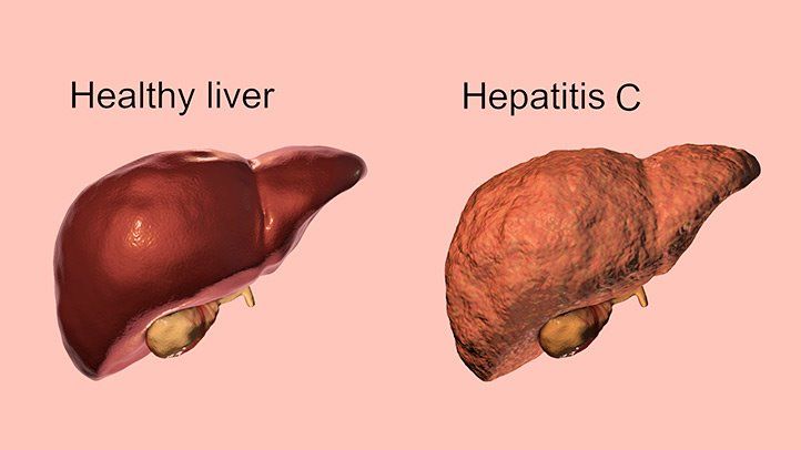 hepatitis c liver